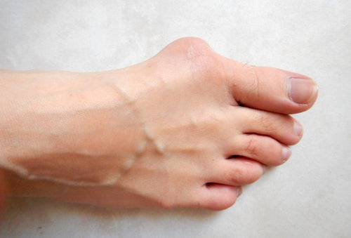 Qu’est-ce que l’hallux valgus et comment le traiter ?