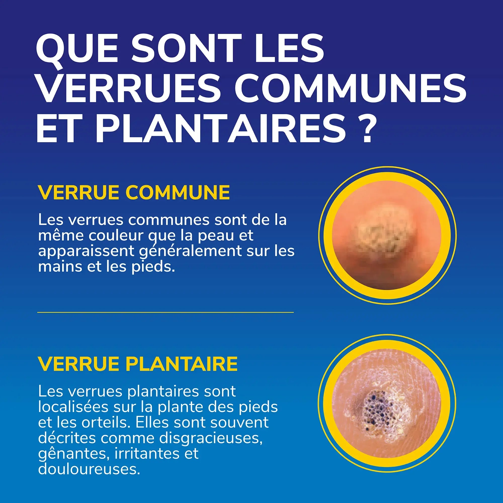 Dr Scholl's Traitement verrues Freeze Away MAX mains et pieds par cryothérapie